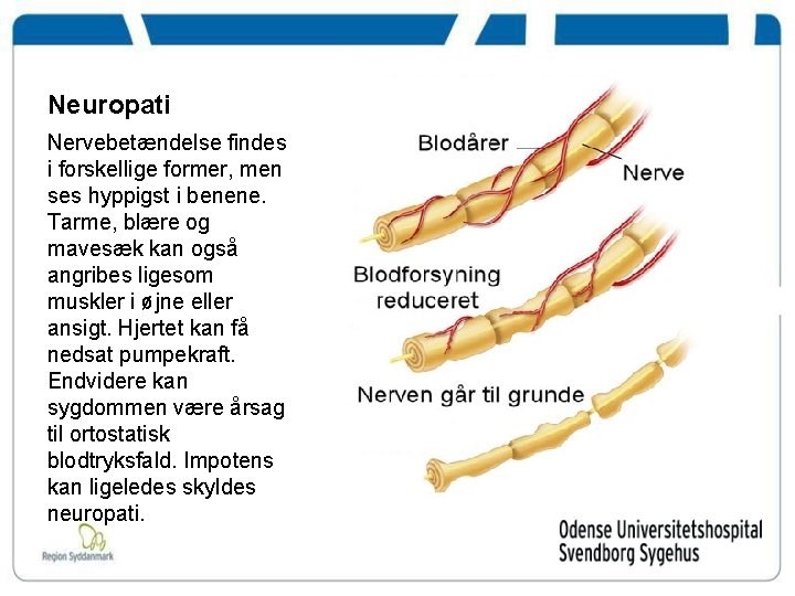 Neuropati Nervebetændelse findes i forskellige former, men ses hyppigst i benene. Tarme, blære og