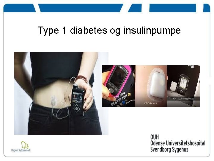 Type 1 diabetes og insulinpumpe 