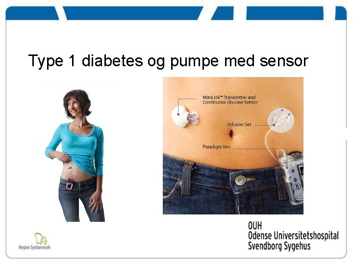 Type 1 diabetes og pumpe med sensor 