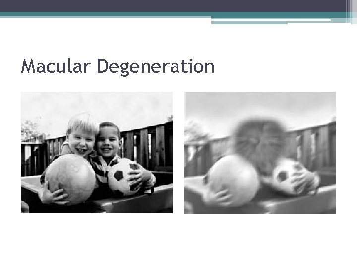 Macular Degeneration 