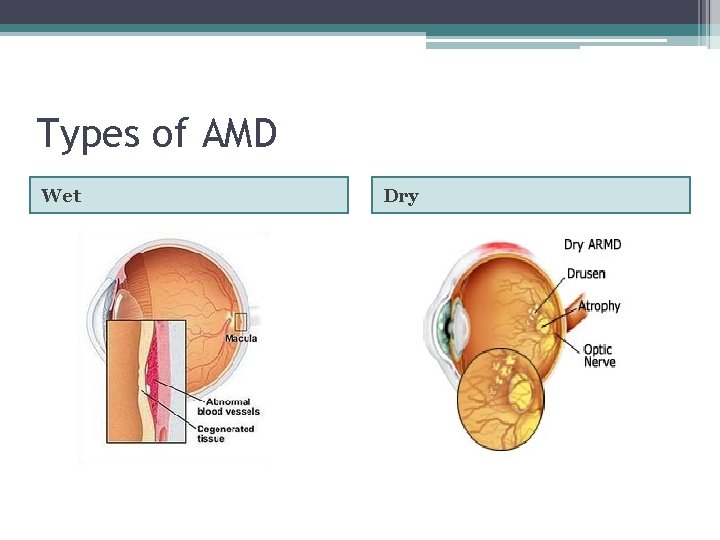 Types of AMD Wet Dry 