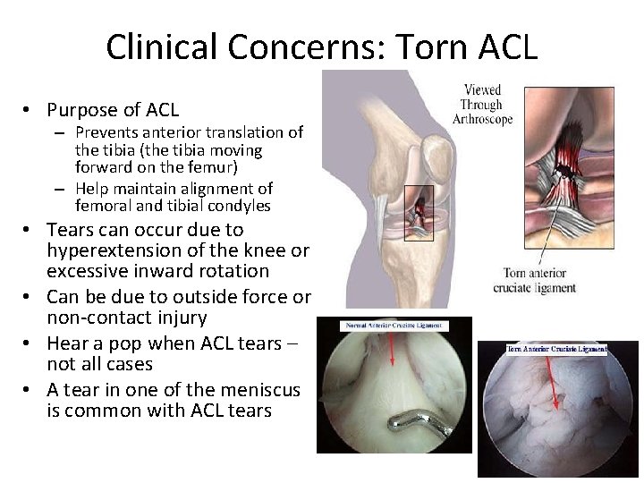 Clinical Concerns: Torn ACL • Purpose of ACL – Prevents anterior translation of the