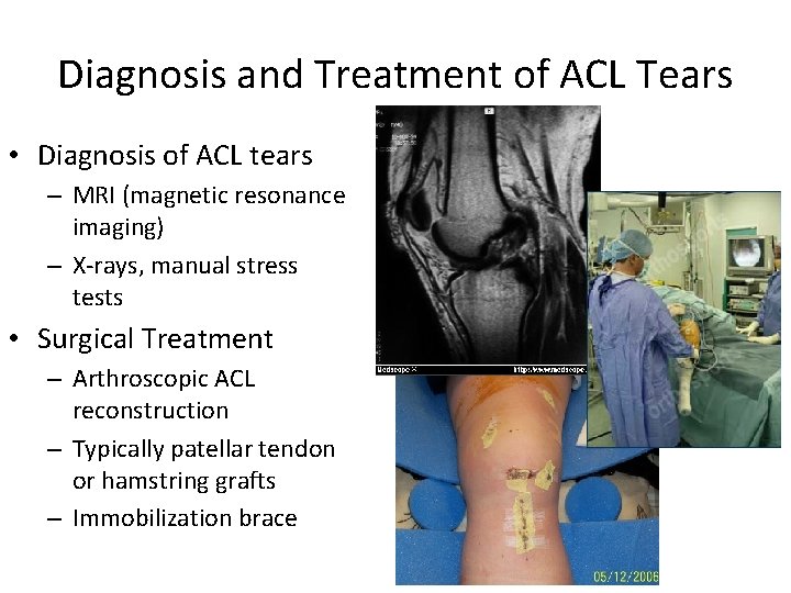 Diagnosis and Treatment of ACL Tears • Diagnosis of ACL tears – MRI (magnetic
