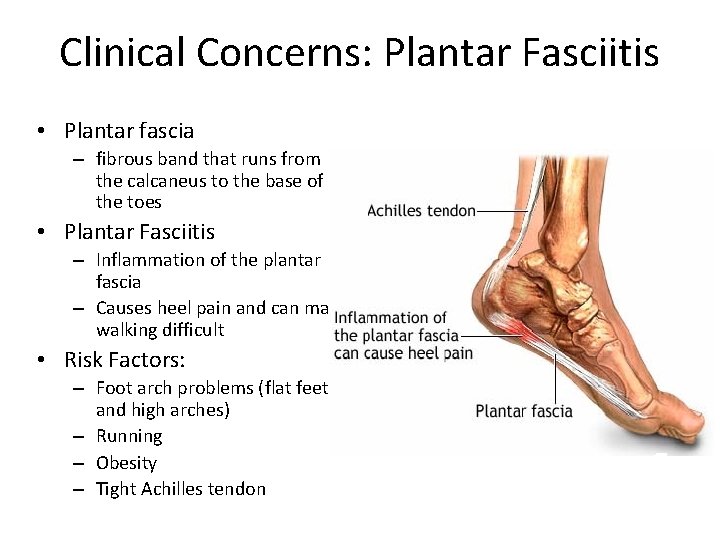 Clinical Concerns: Plantar Fasciitis • Plantar fascia – fibrous band that runs from the