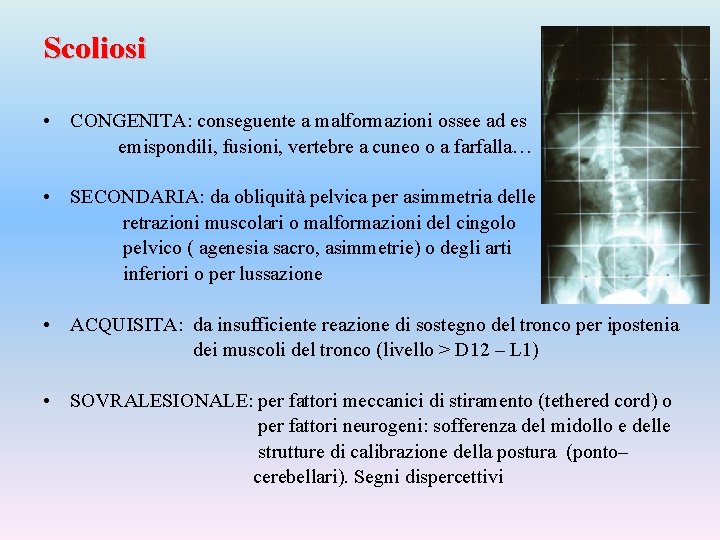 Scoliosi • CONGENITA: conseguente a malformazioni ossee ad es emispondili, fusioni, vertebre a cuneo