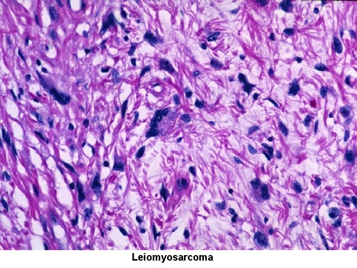 Leiomyosarcoma 