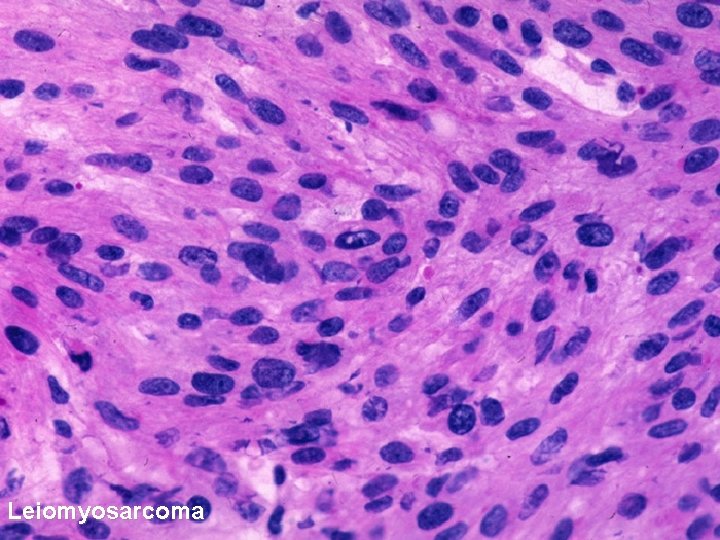 Leiomyosarcoma 