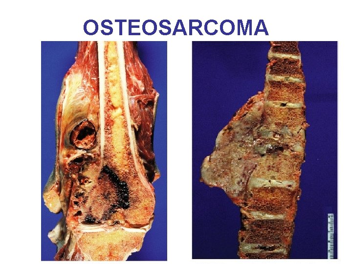 OSTEOSARCOMA 