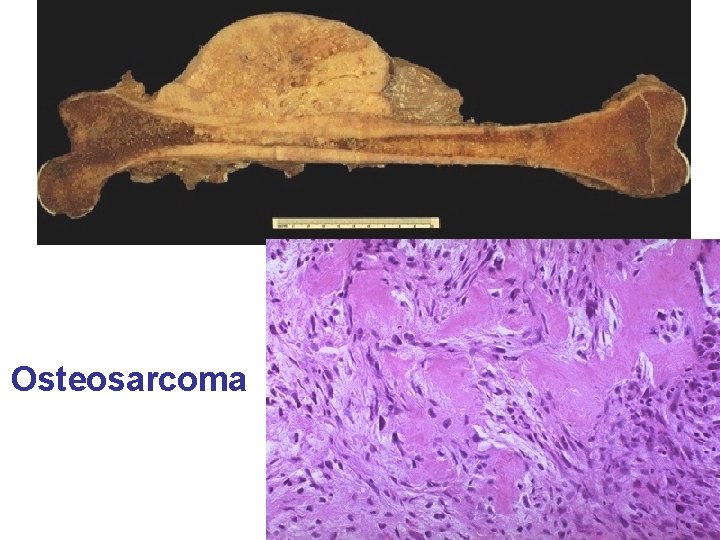 Osteosarcoma 