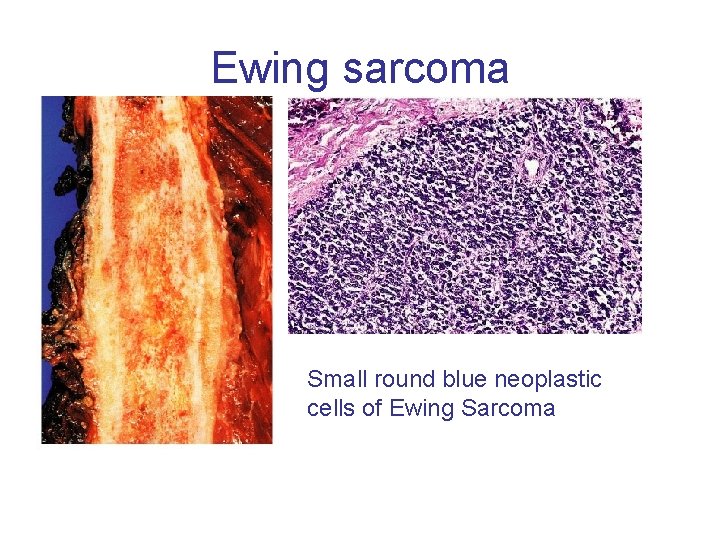 Ewing sarcoma Small round blue neoplastic cells of Ewing Sarcoma 
