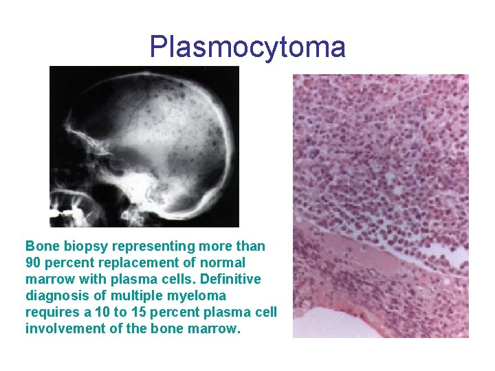 Plasmocytoma Bone biopsy representing more than 90 percent replacement of normal marrow with plasma