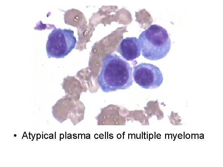  • Atypical plasma cells of multiple myeloma 