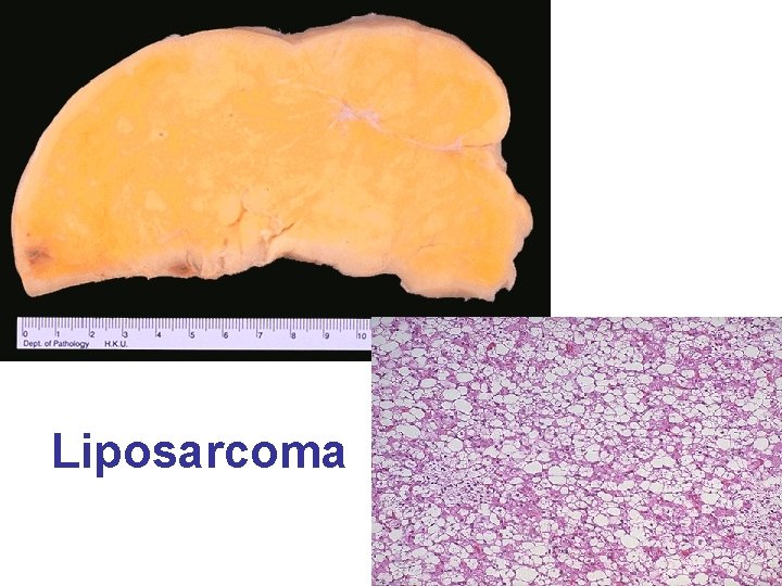 Liposarcoma 