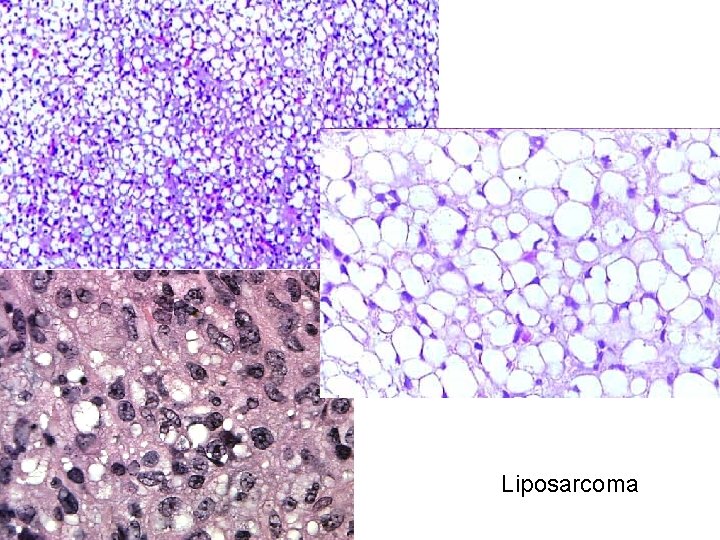 Liposarcoma 