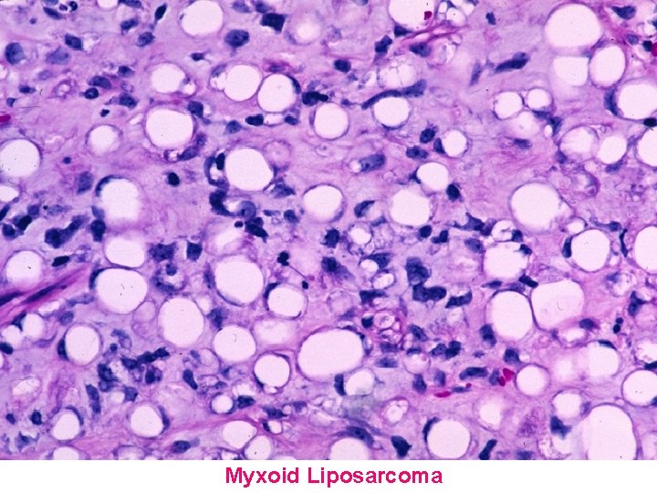 Myxoid Liposarcoma 