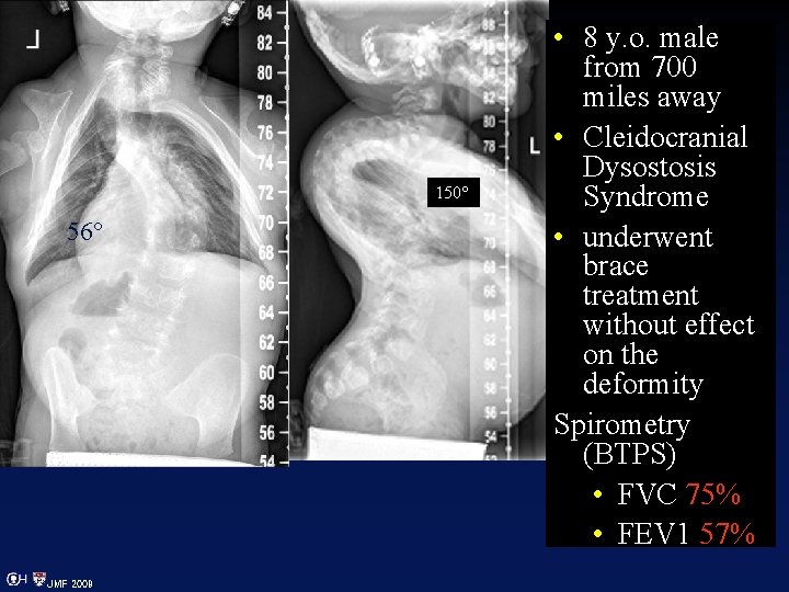 150° 56° JMF 2009 • 8 y. o. male from 700 miles away •