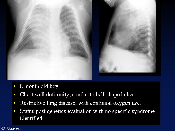  • • 8 month old boy Chest wall deformity, similar to bell-shaped chest.