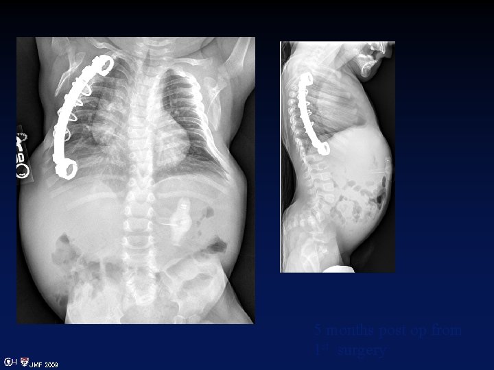 5 months post op from 1 st surgery JMF 2009 