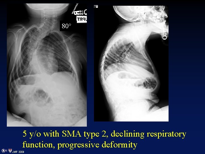 80° 5 y/o with SMA type 2, declining respiratory function, progressive deformity JMF 2009