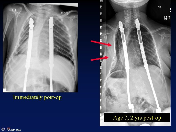 Immediately post-op Age 7, 2 yrs post-op JMF 2009 