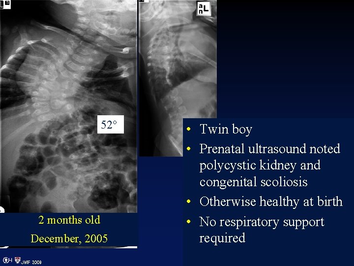 52° 2 months old December, 2005 JMF 2009 • Twin boy • Prenatal ultrasound