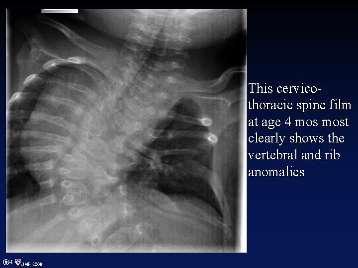 This cervicothoracic spine film at age 4 most clearly shows the vertebral and rib