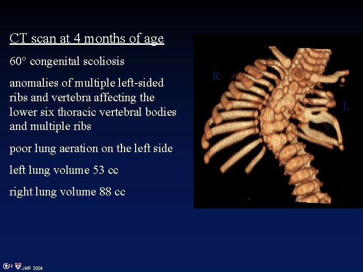 CT scan at 4 months of age 60° congenital scoliosis anomalies of multiple left-sided