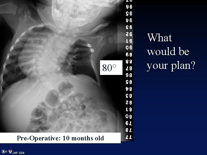 80° Pre-Operative: 10 months old JMF 2009 What would be your plan? 