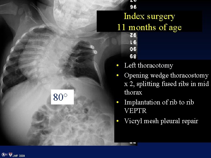 Index surgery 11 months of age 80° JMF 2009 • Left thoracotomy • Opening