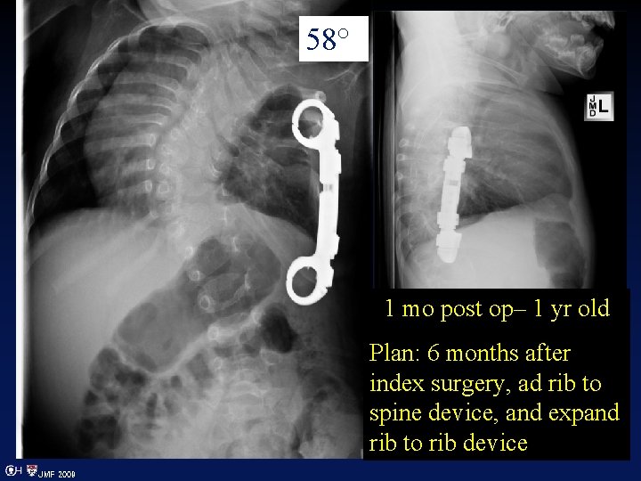 58° 1 mo post op– 1 yr old Plan: 6 months after index surgery,