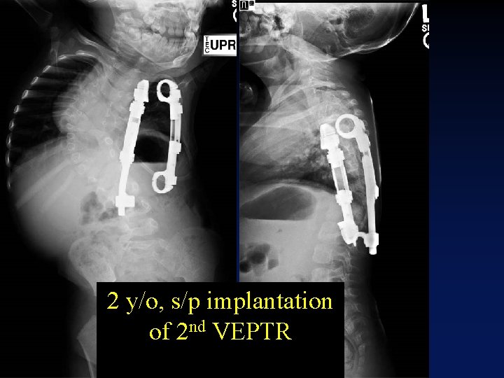 2 y/o, s/p implantation of 2 nd VEPTR JMF 2009 