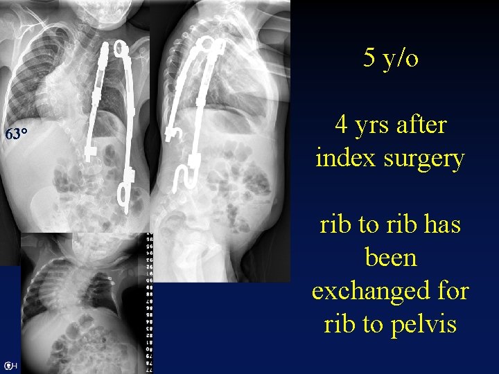 5 y/o 4 yrs after index surgery 63° rib to rib has been exchanged