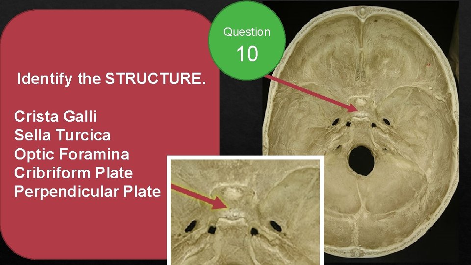 Question 10 Identify the STRUCTURE. Crista Galli Sella Turcica Optic Foramina Cribriform Plate Perpendicular