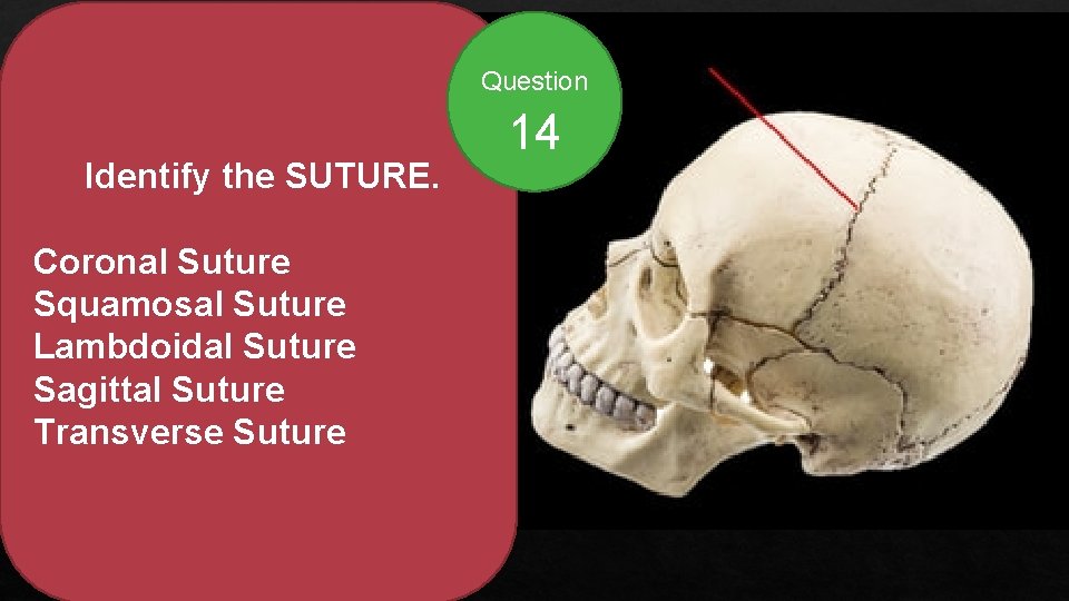 Question Identify the SUTURE. Coronal Suture Squamosal Suture Lambdoidal Suture Sagittal Suture Transverse Suture