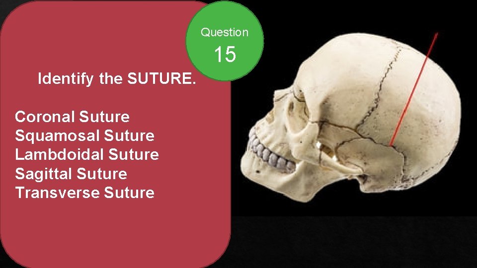 Question 15 Identify the SUTURE. Coronal Suture Squamosal Suture Lambdoidal Suture Sagittal Suture Transverse