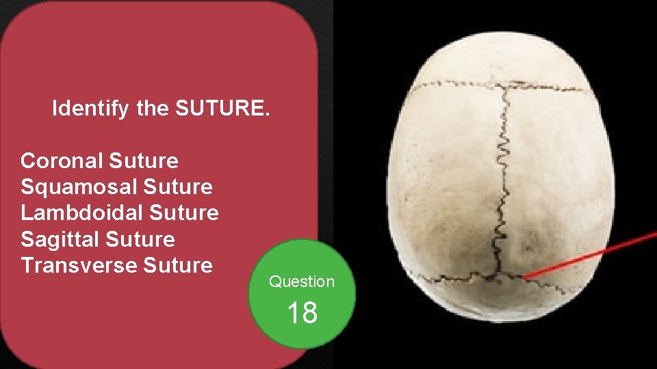Identify the SUTURE. Coronal Suture Squamosal Suture Lambdoidal Suture Sagittal Suture Transverse Suture Question