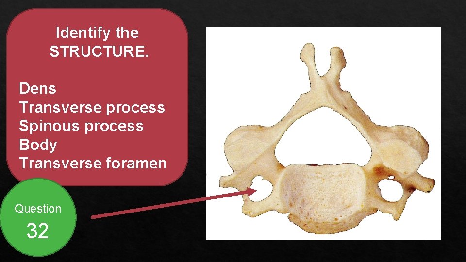 Identify the STRUCTURE. Dens Transverse process Spinous process Body Transverse foramen Question 32 