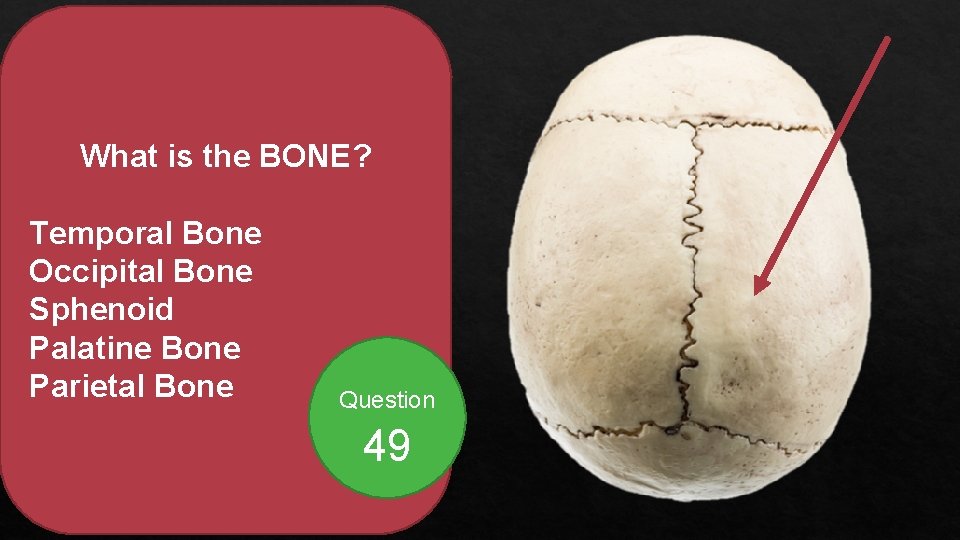 What is the BONE? Temporal Bone Occipital Bone Sphenoid Palatine Bone Parietal Bone Question