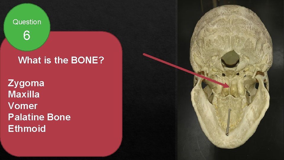Question 6 What is the BONE? Zygoma Maxilla Vomer Palatine Bone Ethmoid 