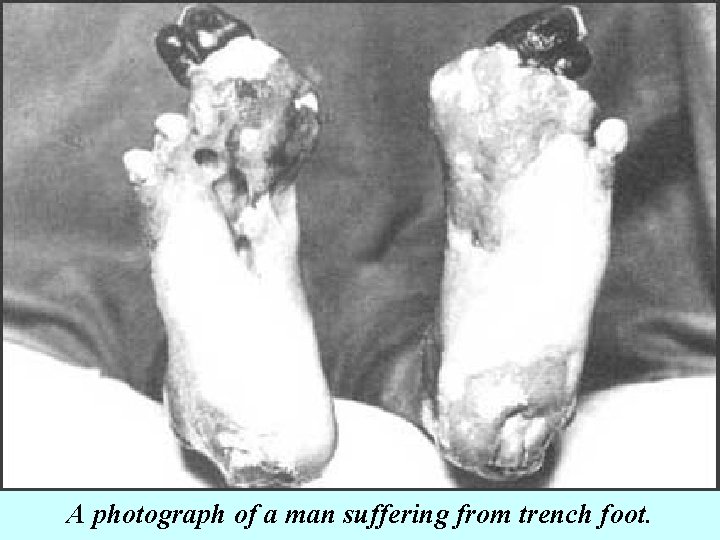 A photograph of a man suffering from trench foot. 