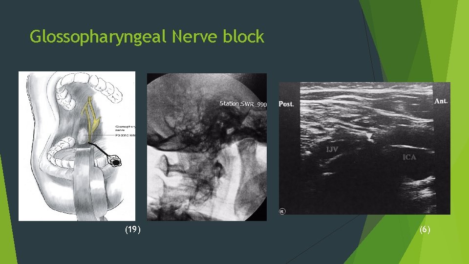 Glossopharyngeal Nerve block (19) (6) 