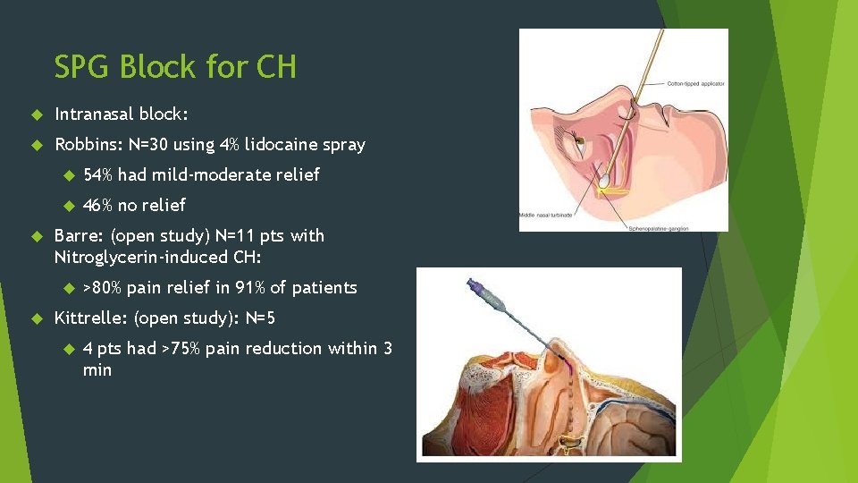 SPG Block for CH Intranasal block: Robbins: N=30 using 4% lidocaine spray 54% had