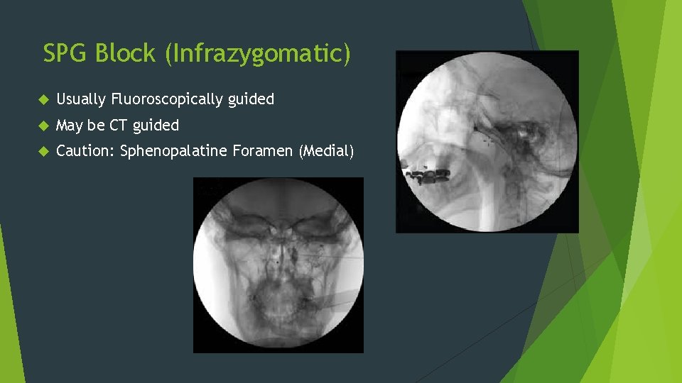 SPG Block (Infrazygomatic) Usually Fluoroscopically guided May be CT guided Caution: Sphenopalatine Foramen (Medial)