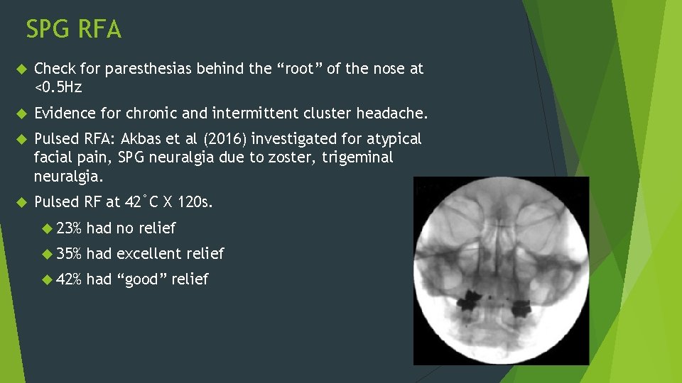 SPG RFA Check for paresthesias behind the “root” of the nose at <0. 5