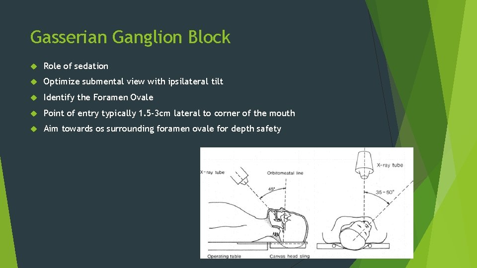 Gasserian Ganglion Block Role of sedation Optimize submental view with ipsilateral tilt Identify the