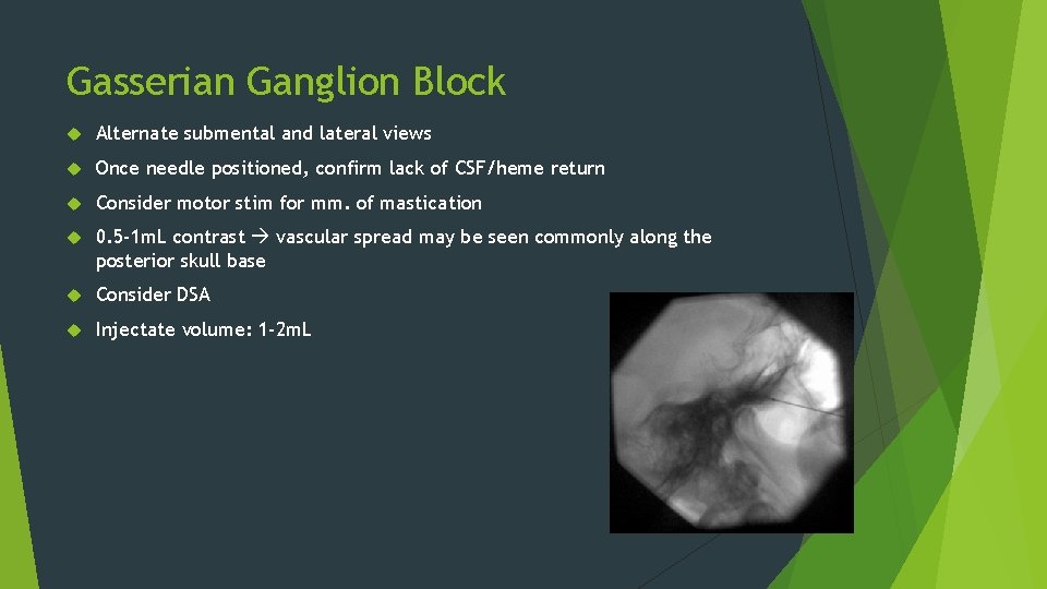 Gasserian Ganglion Block Alternate submental and lateral views Once needle positioned, confirm lack of