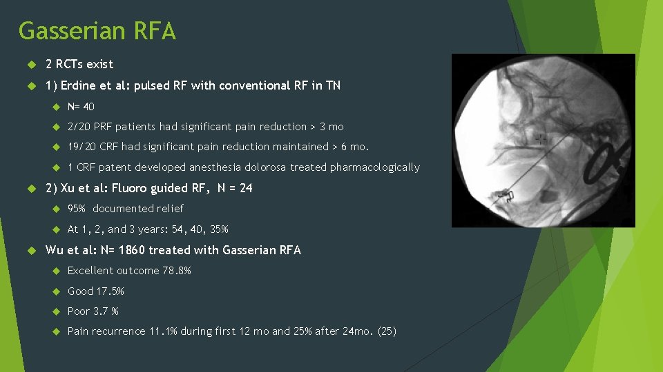 Gasserian RFA 2 RCTs exist 1) Erdine et al: pulsed RF with conventional RF