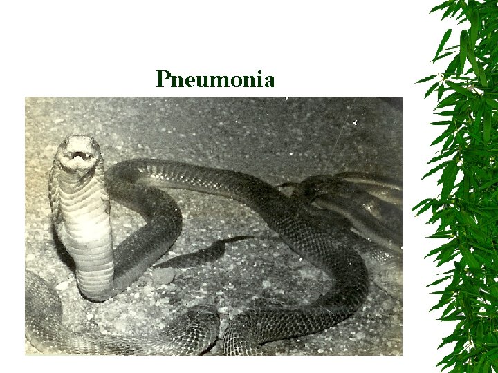 Pneumonia 