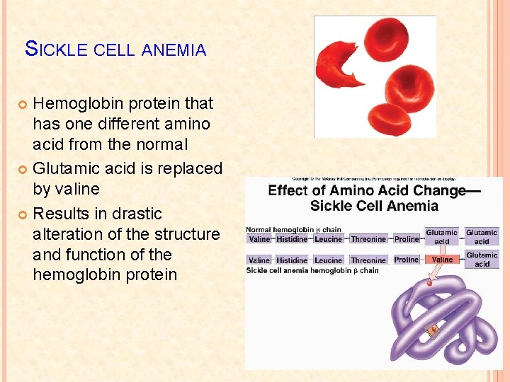 SICKLE CELL ANEMIA Hemoglobin protein that has one different amino acid from the normal