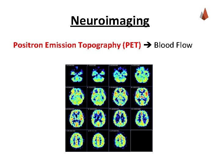 Neuroimaging Positron Emission Topography (PET) Blood Flow 